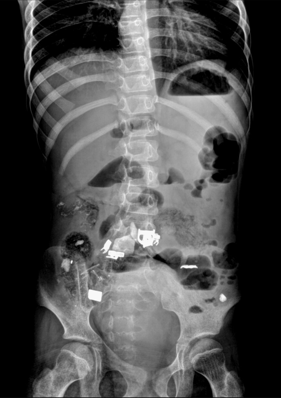 Инородное тело брюшной полости после операции. Рентген инородное тело в ЖКТ. Инородное тело в кишечнике рентген.